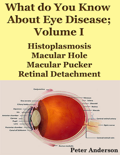What Do You Know About Eye Disease; Volume I: Histoplasmosis, Macular Hole, Macular Pucker and Retinal Detachment