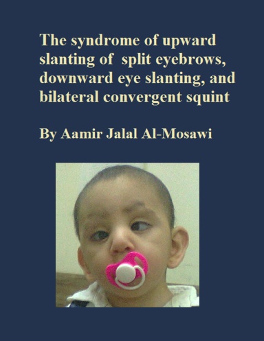 The Syndrome Of Upward Slanting Of Split Eyebrows, Downward Eye ...