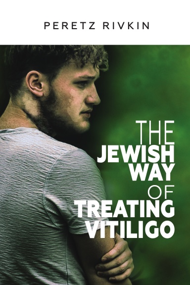 The Jewish Way of Treating Vitiligo