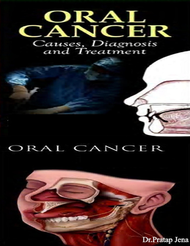 Oral Cancer Causes Diagnosis Treatment and Prevent