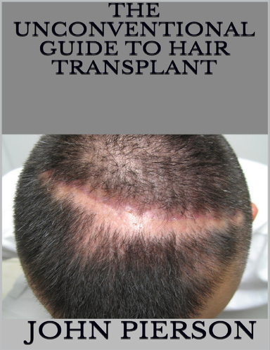 The Unconventional Guide to Hair Transplant
