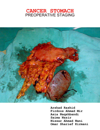 CANCER STOMACH: PREOPERATIVE STAGING