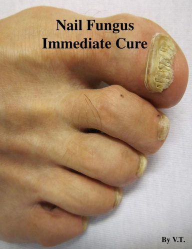 Nail Fungus Immediate Cure
