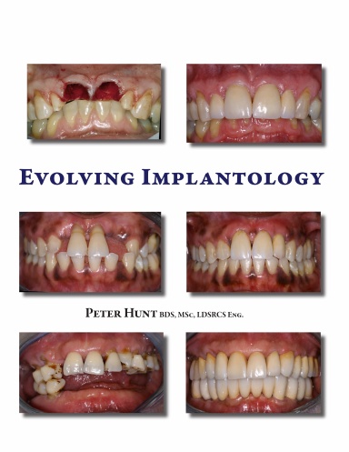 Evolving Implantology