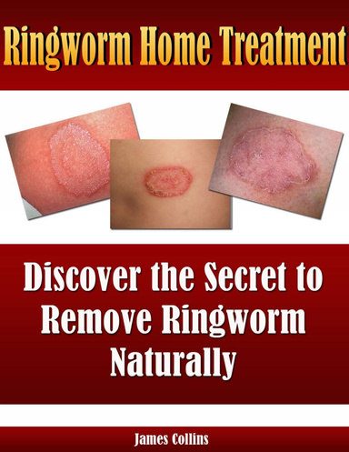 Ringworm Home Treatment: Discover the Secret to Remove Ringworm Naturally
