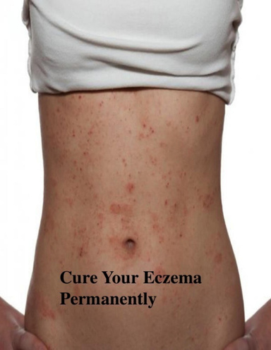 Cure Your Eczema Permanently