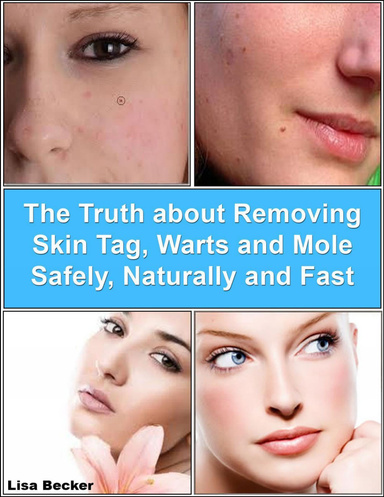 The Truth About Removing Skin Tag, Warts and Mole Safely, Naturally and Fast