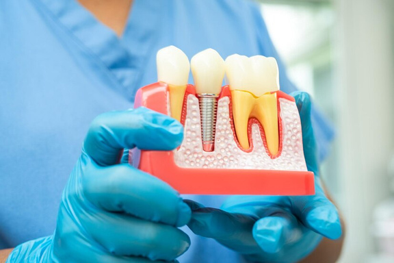 Dental Implants: The Perfect Solution for Missing Teeth