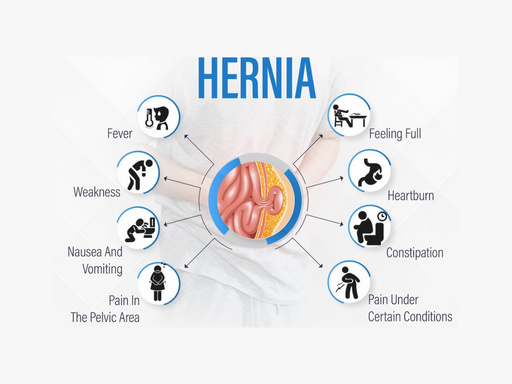 Hernia Symptoms