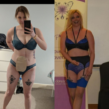 Weight loss