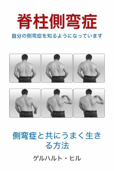 脊柱側弯症