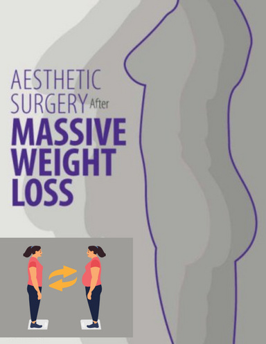 Aesthetic Surgery After Massive Weight Loss
