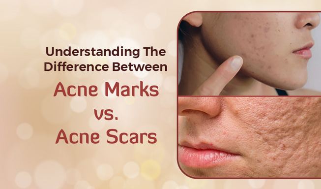 Understanding The Difference Between Acne Marks vs Acne Scars