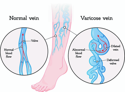 Varicose veins Latest Treatment
