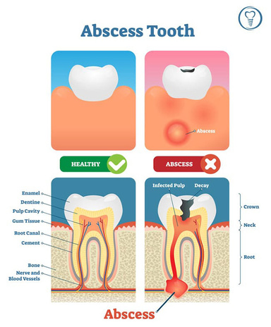 Abscessed Teeth