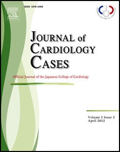 Giant congenital left ventricular diverticulum associated with infective endocarditis: A diagnosis made by tissue Doppler echocardiography