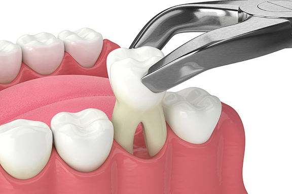 What Happens During an Emergency Dental Extraction? | Katy, TX