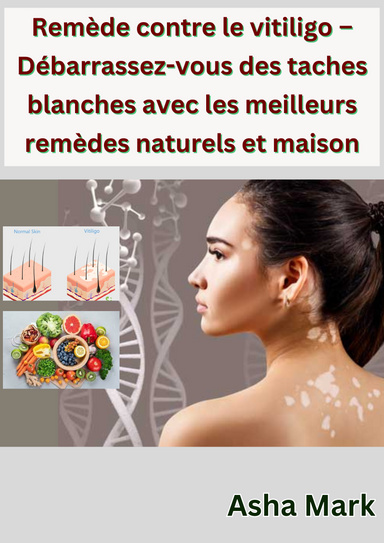 Remède contre le vitiligo – Débarrassez-vous des taches blanches avec les meilleurs remèdes naturels et maison