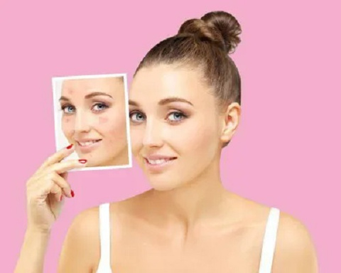 Acne Scars Treatment
