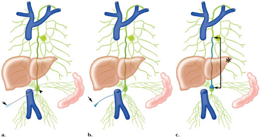 Lymphangiography Treatment In India