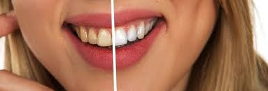 Steel Bite Tooth Protection