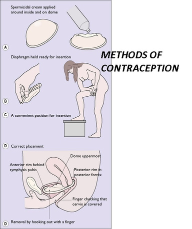 Contraception