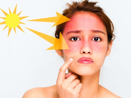 Sunburn: Top 7 latest Natural Solutions to Soothe Skin