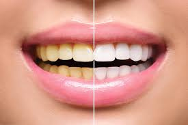 AFree Few Secrets About Teeth Whitening