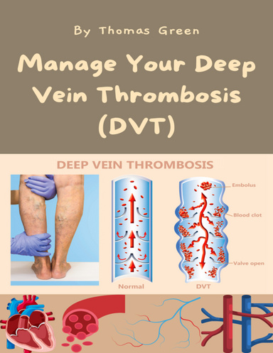 Manage Your Deep Vein Thrombosis (DVT)