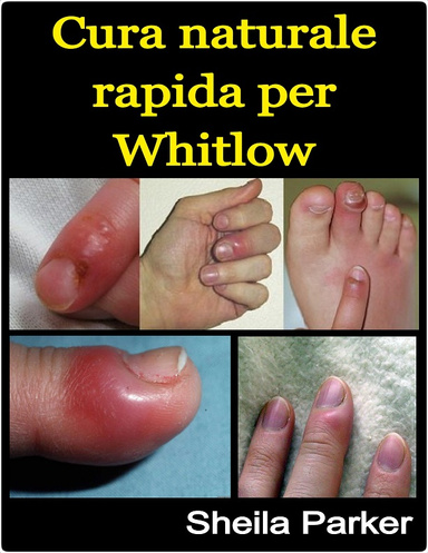 Cura naturale rapida per Whitlow