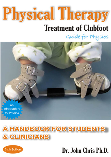 Physical Therapy Treatment of Clubfoot Guide for Physios