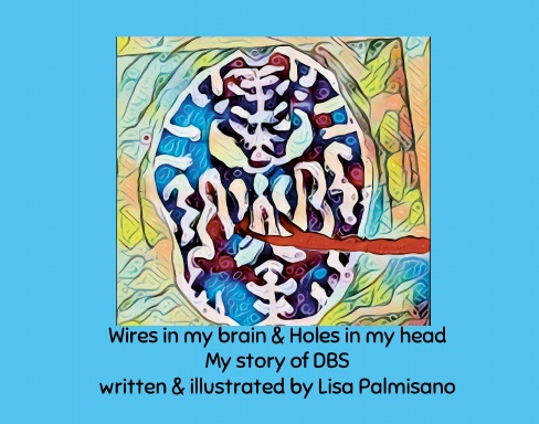 Wires in my Brain and Holes in my head (my story of DBS)