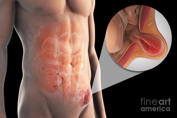 Hernia Exercises a Guide to Safe and Effective Movement