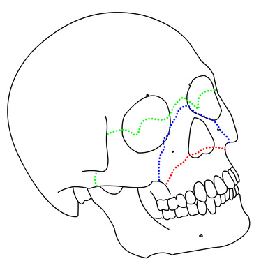 fractures of upper jaw