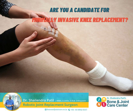 Do you know? Best  total knee replacement surgeon in Mumbai