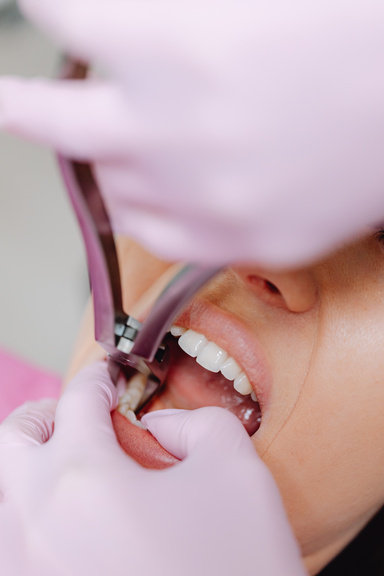 Emergency Dental Extraction  | Katy, TX