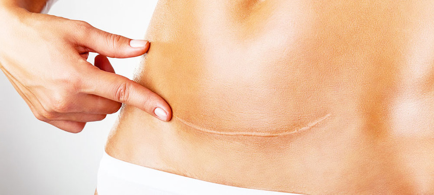 Scar Removal Treatment In Delhi