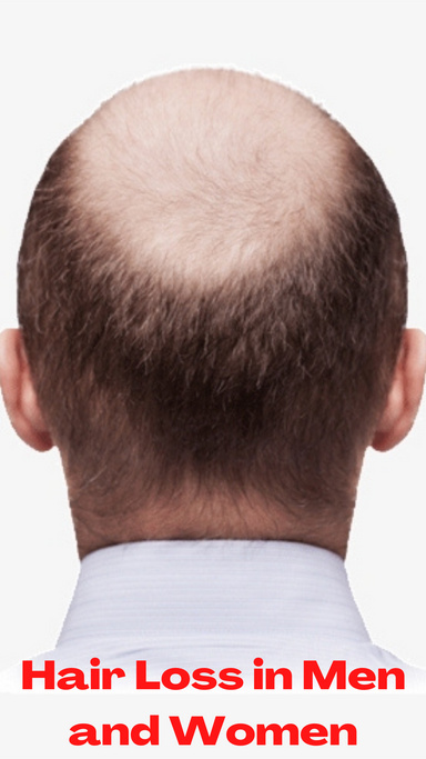 Hair Loss in Men And Women - Is It A Real Nightmare