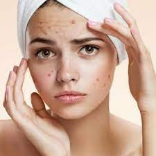 How to clear Acne?